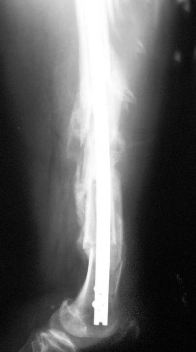 Retrograde Femoral Rod (Implant 234)